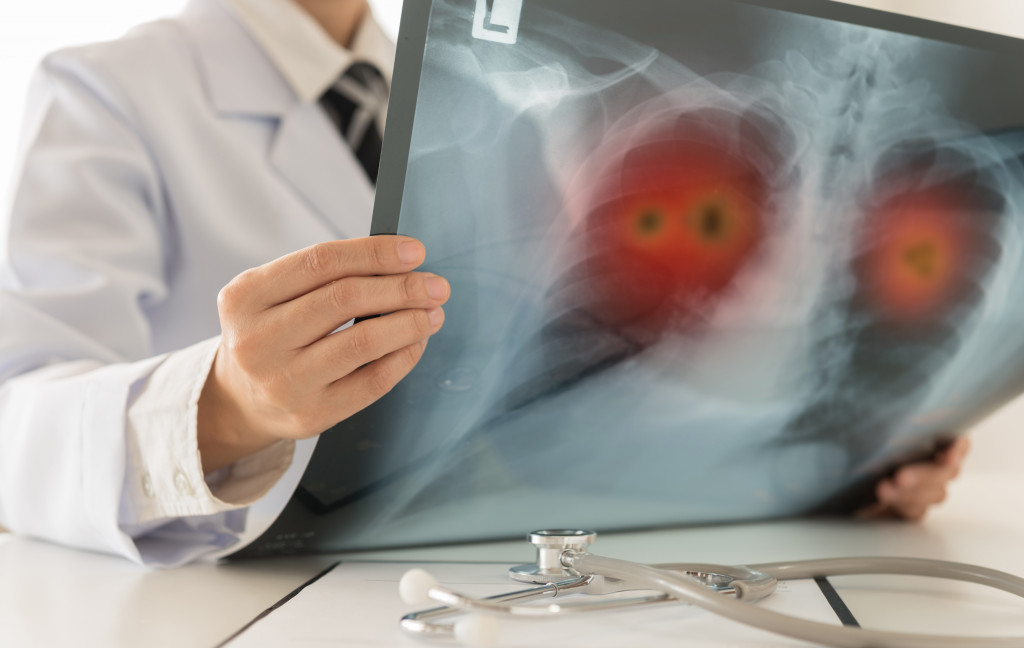 lung cancer xray held by doctor